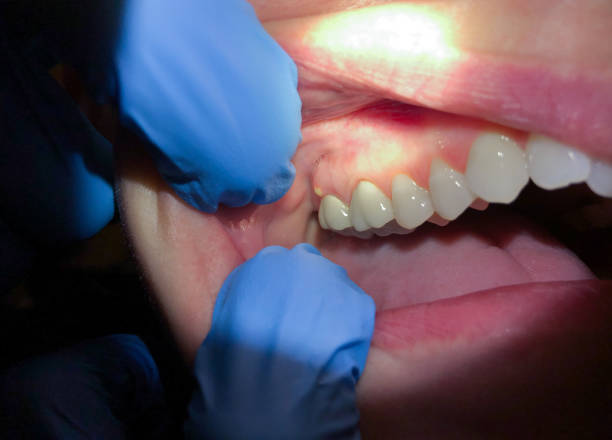 Best Emergency Treatment for Dental Infections or Abscesses in Inman, SC